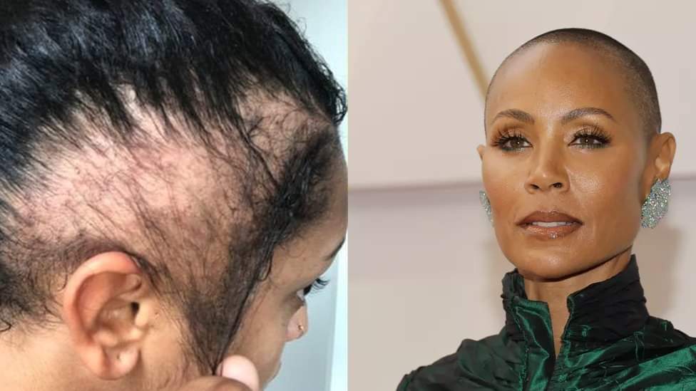 Como evitar a queda de cabelo: alopecia, a doença da mulher de Will Smith