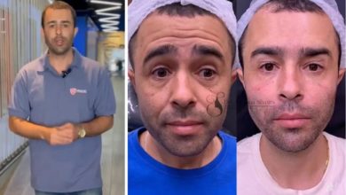 Motorista que atropelou Kayky Brito faz harmonização facial