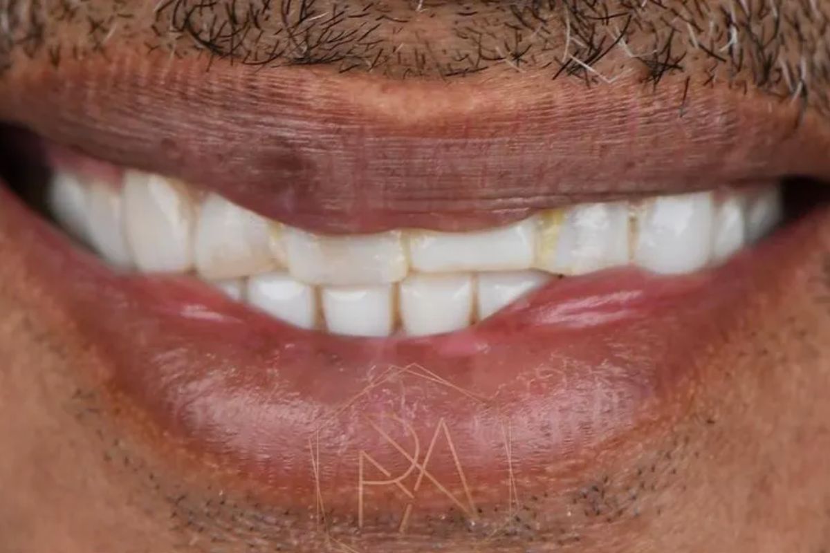 Dentes de Manoel Gomes antes de colocar lentes (Foto: Reprodução/Instagram)