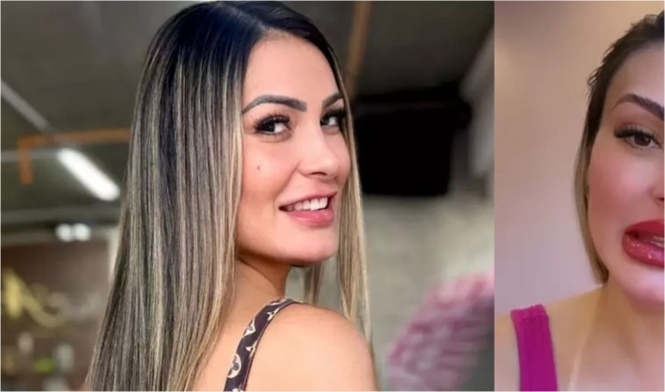 Como ficou a boca de Andressa Urach após novo procedimento: ela disse que gostou muito